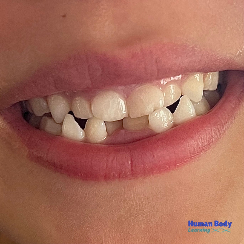 child with crooked teeth and dents from chronic nail biting