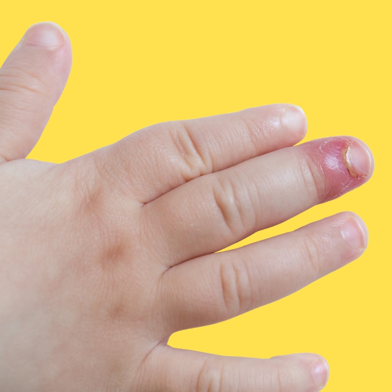infected skin around fingernail