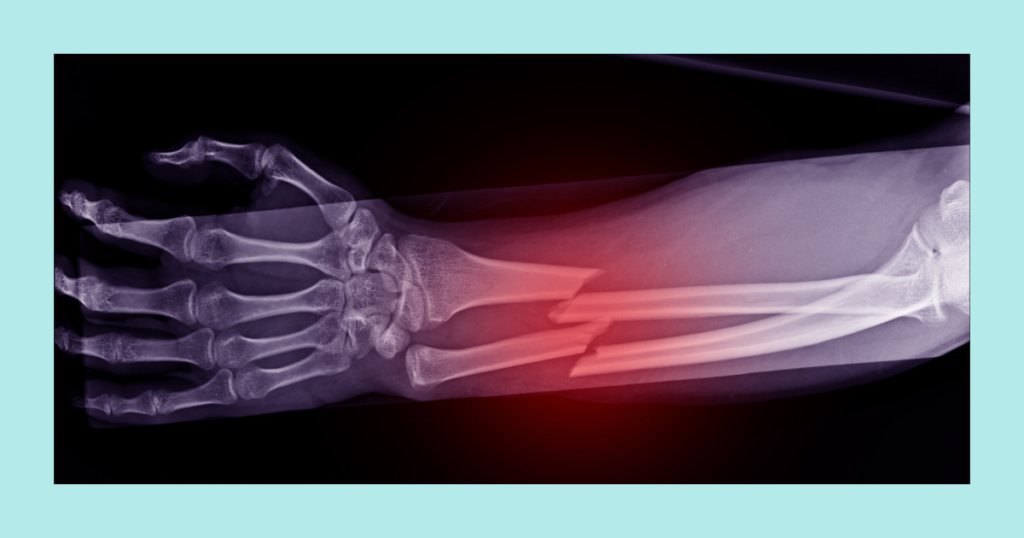 difference between broken forearm bones and fracture of the radius and ulna