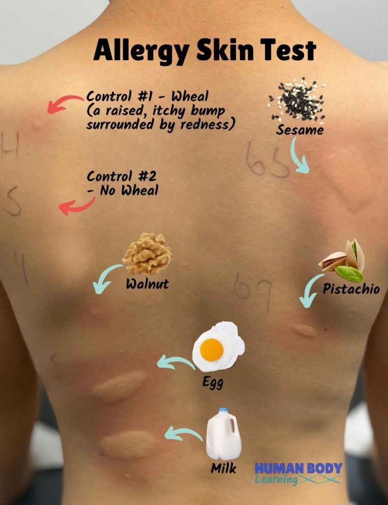 Skin Prick Allergy Testing for Food Allergies