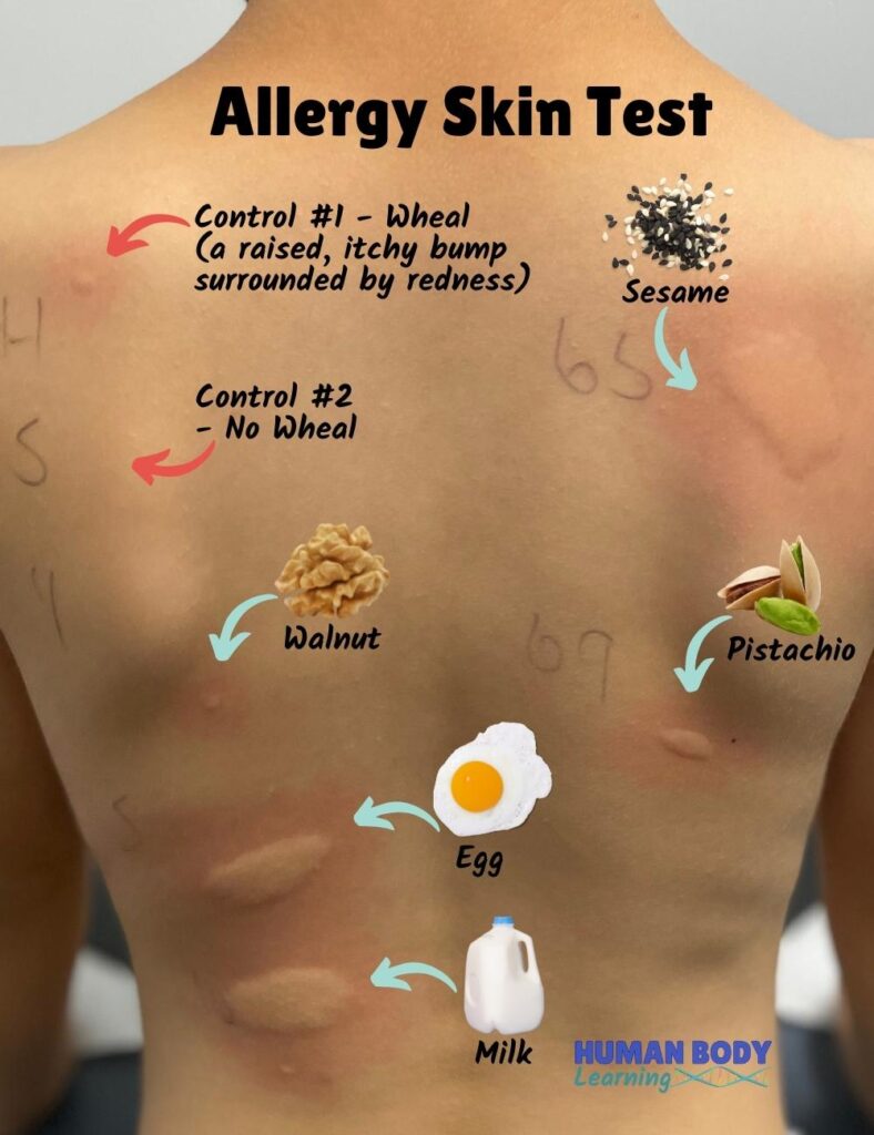 skin prick food allergy testing on a child's back