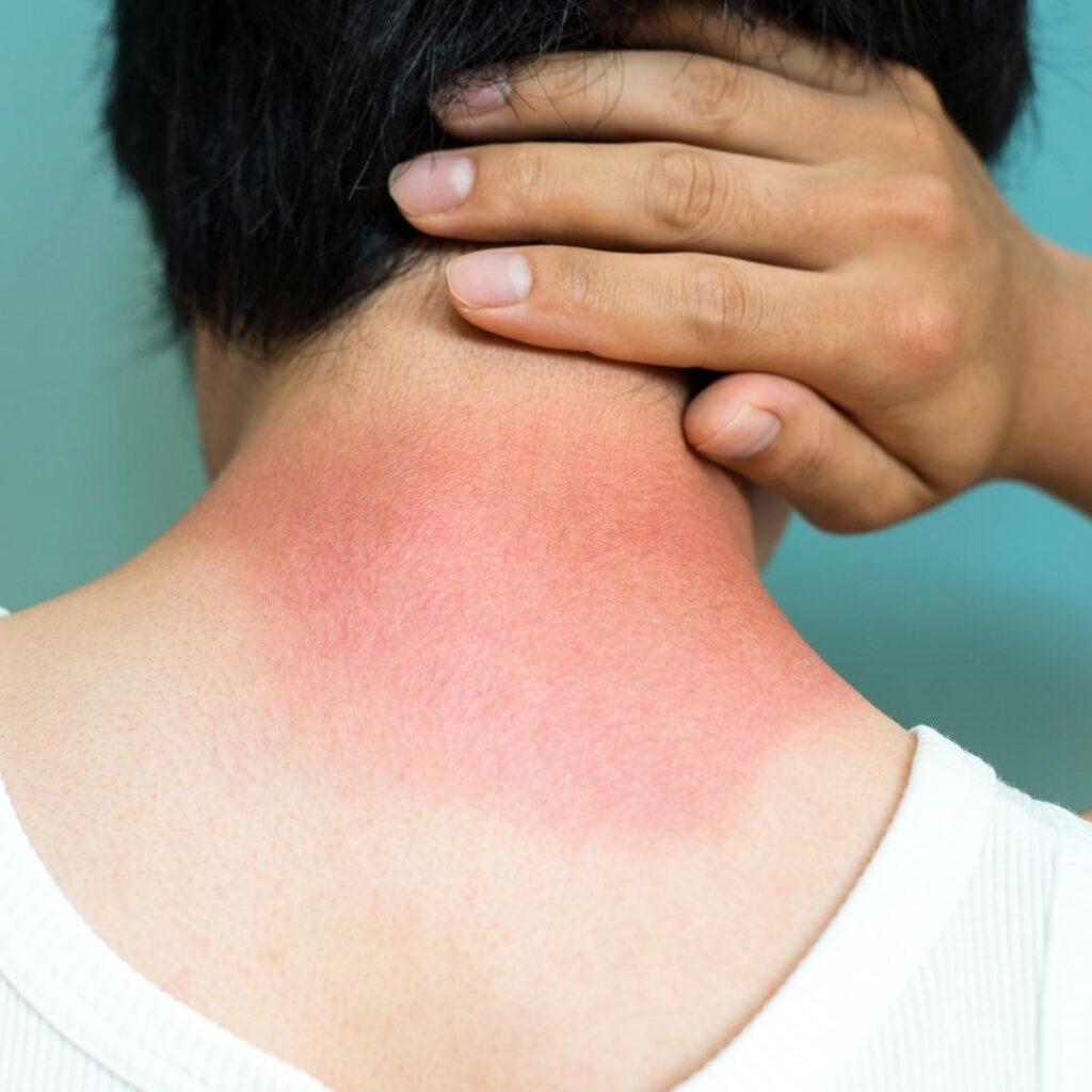 Neck sunburn - painful, red, itchy, uncomfortable skin