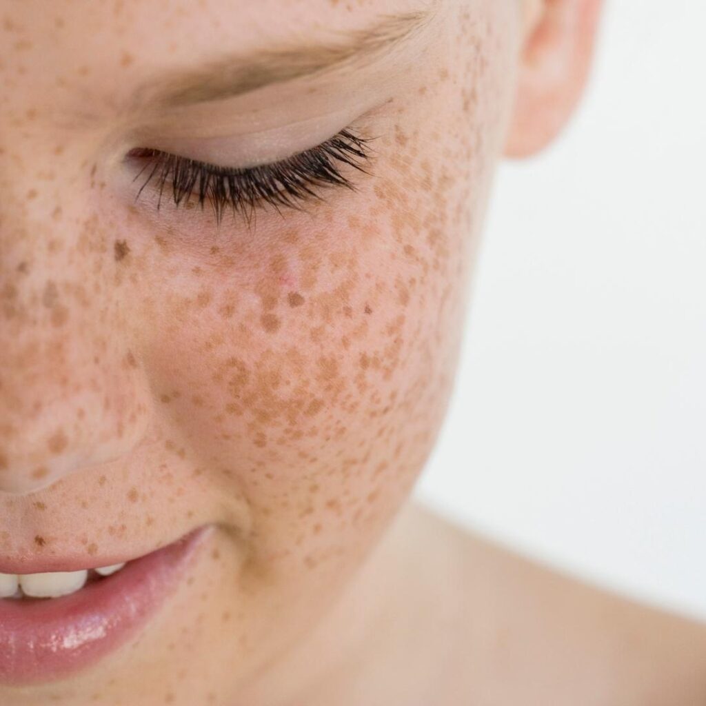 face freckles on a child