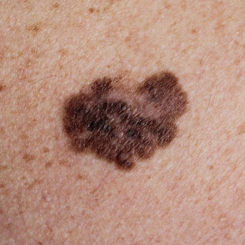 melanoma skin cancer - risk of too much sun exposure without no protection