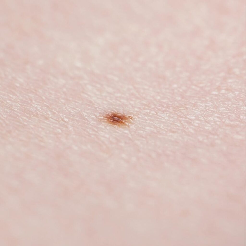 small mole on fair skin