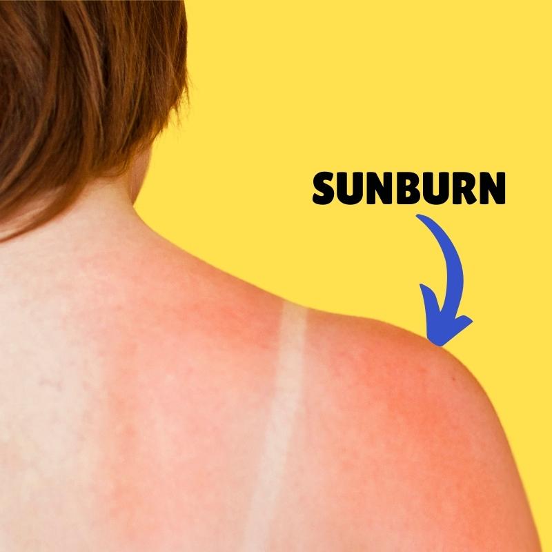 sunburned skin - painful, red, itchy, uncomfortable