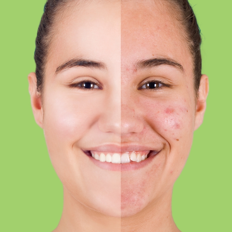 pimples on skin puberty