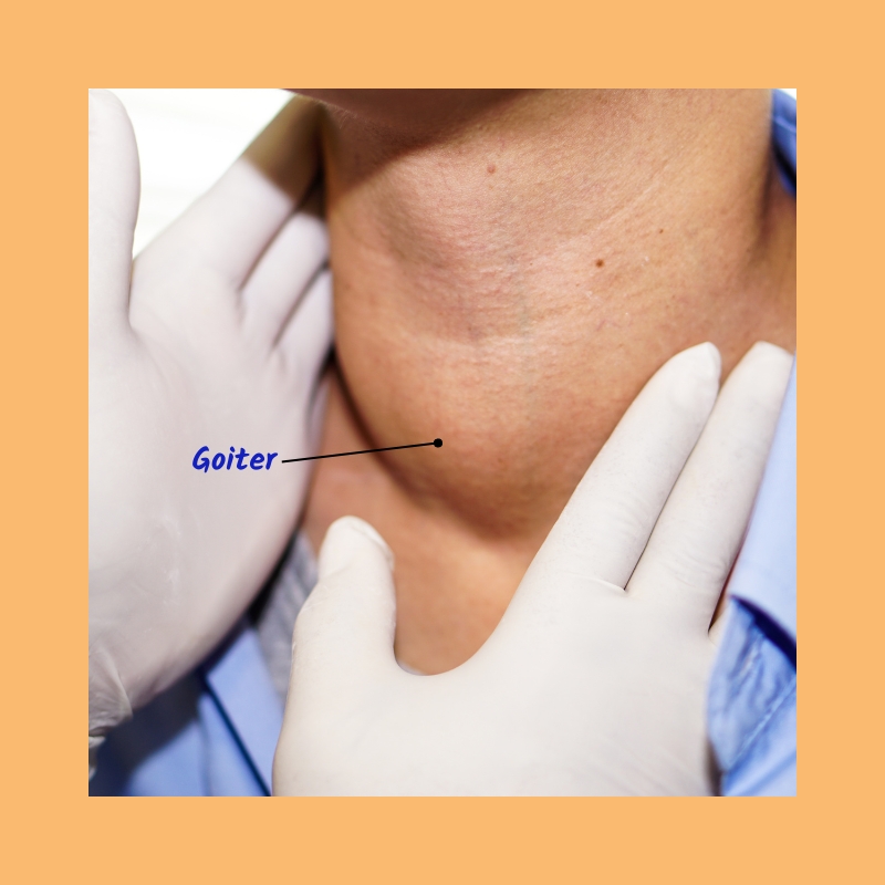 goiter enlarged thyroid gland in neck